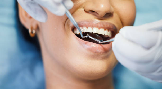 Best Knocked-Out Tooth (Avulsed Tooth) Treatment in Clinton, SC
